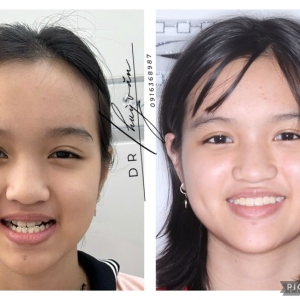 hanh-trinh-chinh-nha-nu-cuoi-hoan-hao-sau-khi-ket-thuc-dieu-tri