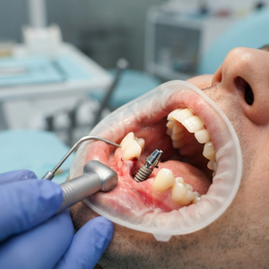 mat-mot-rang-co-the-phuc-hoi-bang-implant-nhu-the-nao